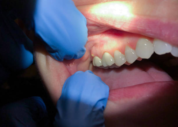 Emergency Cosmetic Dentistry (e.g., broken veneers)